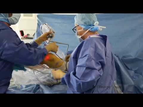 Vidéo du mois décembre 2022 : Anterior cruciate ligament arthroscopic reconstruction and lateral tenodesis with iliotibial band and gracilis tendon