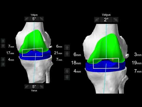 vidéo du mois septembre 2022 : Combining load sensor and robotic technologies for ligament balance in total knee arthroplasty